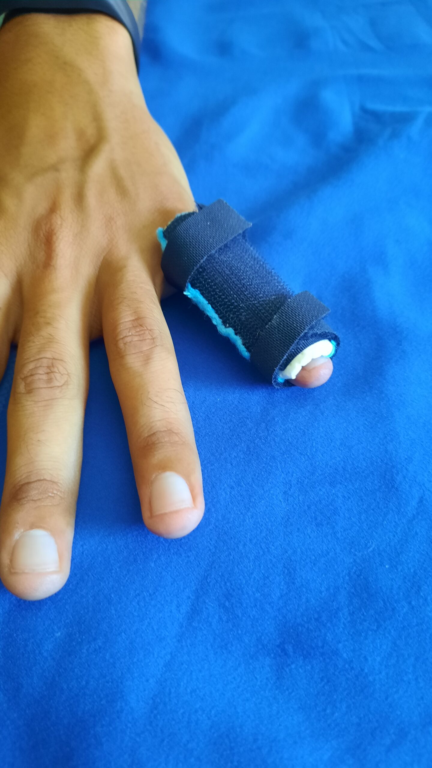 Realizzazione tutori su misura clinica della mano